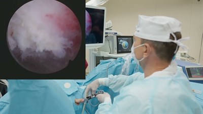 Лазерная энуклеация гиперплазии простаты обьемом 100 см3 с использованием гольмиевого лазера